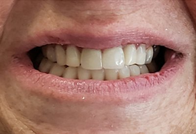 New smile created by full tooth extractions and dental implant overdentures