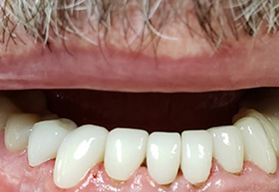 New smile created by full tooth extractions and dental implant overdentures