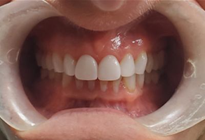 New smile created by full tooth extractions and dental implant overdentures