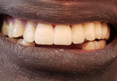 Smile after upper left teeth were replaced with dental bridge