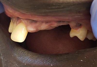 Smile with several upper left missing teeth