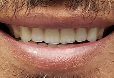 New smile created by full tooth extractions and dental implant overdentures