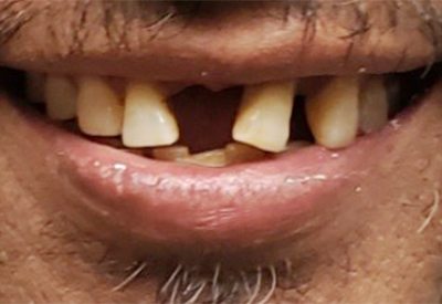 Smile with missing front tooth and many damaged and decayed teeth