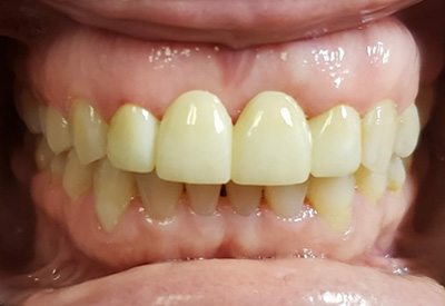 Smile enhanced with dental bridge tooth replacement