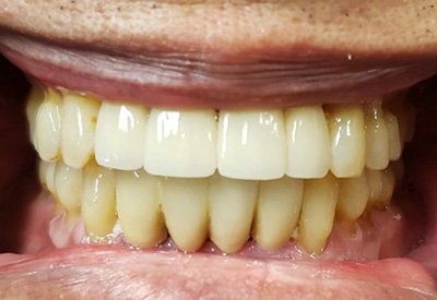 Row of teeth replaced with dental implants