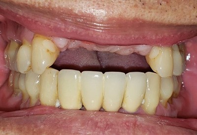 Smile with row of missing teeth