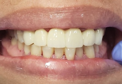Smile after upper front teeth are replaced with a dental bridge