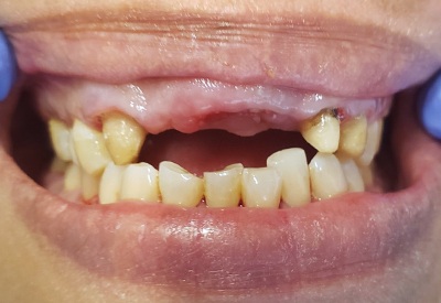 Smile with missing upper front teeth
