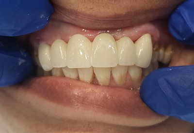 Smile with natural looking new dental bridge