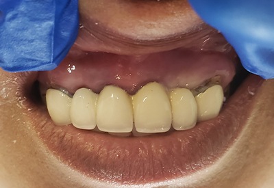 Smile with discolored old dental bridge