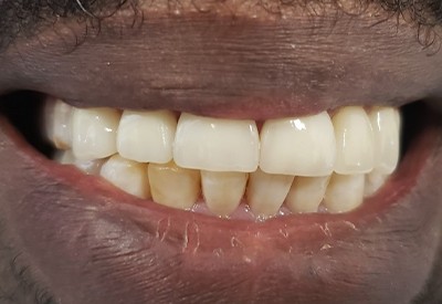 Smile enhanced with porcelain dental veneers