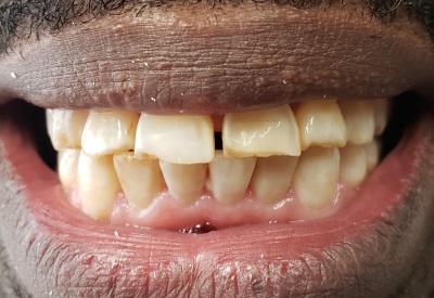 Smile with worn and damaged teeth