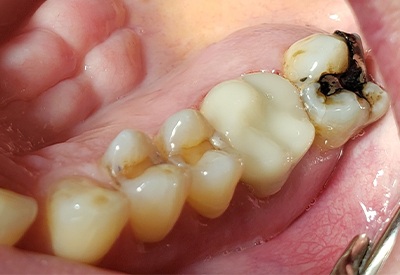 Tooth repaired with a custom CEREC same day dental crown