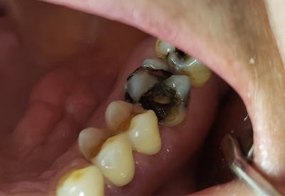 Decayed and broken back tooth