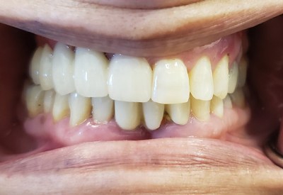 Smile with upper right teeth replaced by dental implant supported restoration