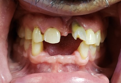 Upper front teeth damaed and decayed and missing lower teeth