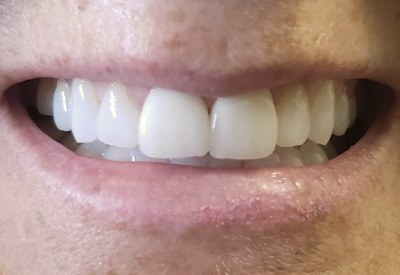 Beautiful smile after porcelain veneer treatment