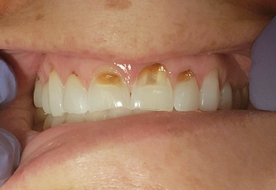 Discolored and damged smile before cosmetic dentistry