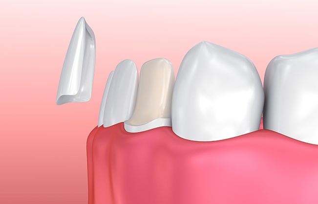 Animated smile during porcelain veneer placement