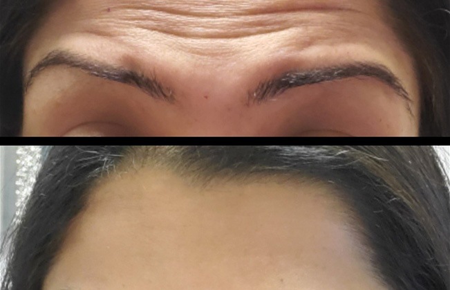 Person's forehead before and after Botox