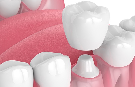 Illustration of crown being placed on prepared tooth