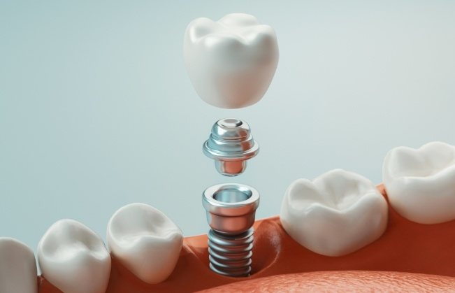 Animated dental implant supported dental crown restoration