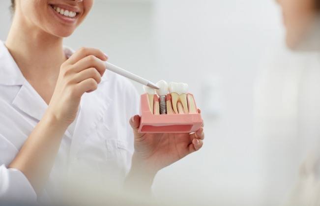 Dentist showing patient a dental implant model