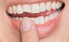 Closeup of smile with chipped front tooth