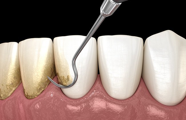 Animated smile during scaling and root planing treatment