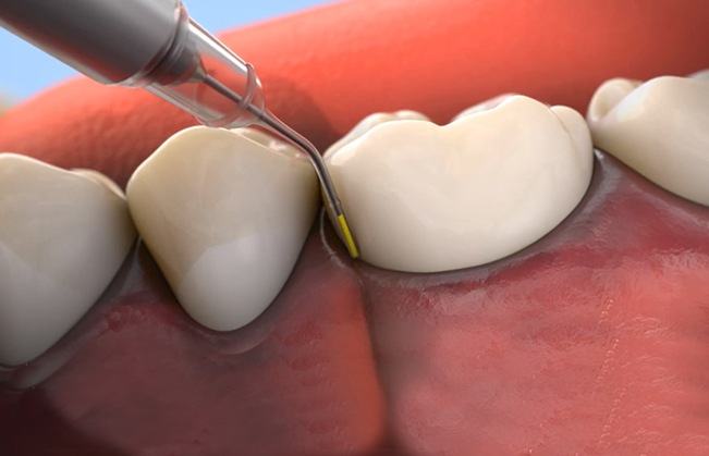 Animated smile during topical antibiotic treatment