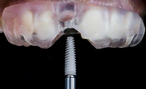 Surgical guide for dental implants in Auburn on patient’s mouth