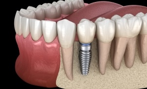 Animated smile with dental implant supported dental crown