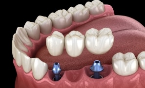 Animated dental implant supported fixed bridge placement