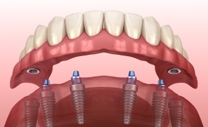 Animated dental implant supported denture placement