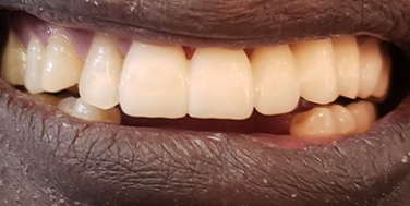 Perfected smile after replacing missing teeth