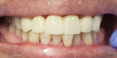 Healthy smile after tooth replacement