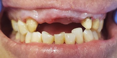 Smile with row of missing top teeth