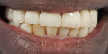 Healthy beautiful smile after dental restoration