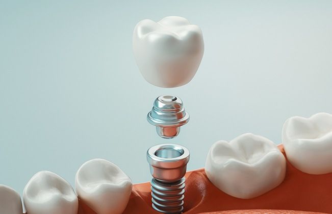 Animated dental implant supported dental crown placement