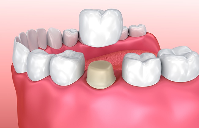 Animated smile during dental crown placement