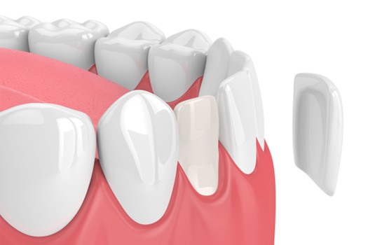 Model of veneer for lower tooth